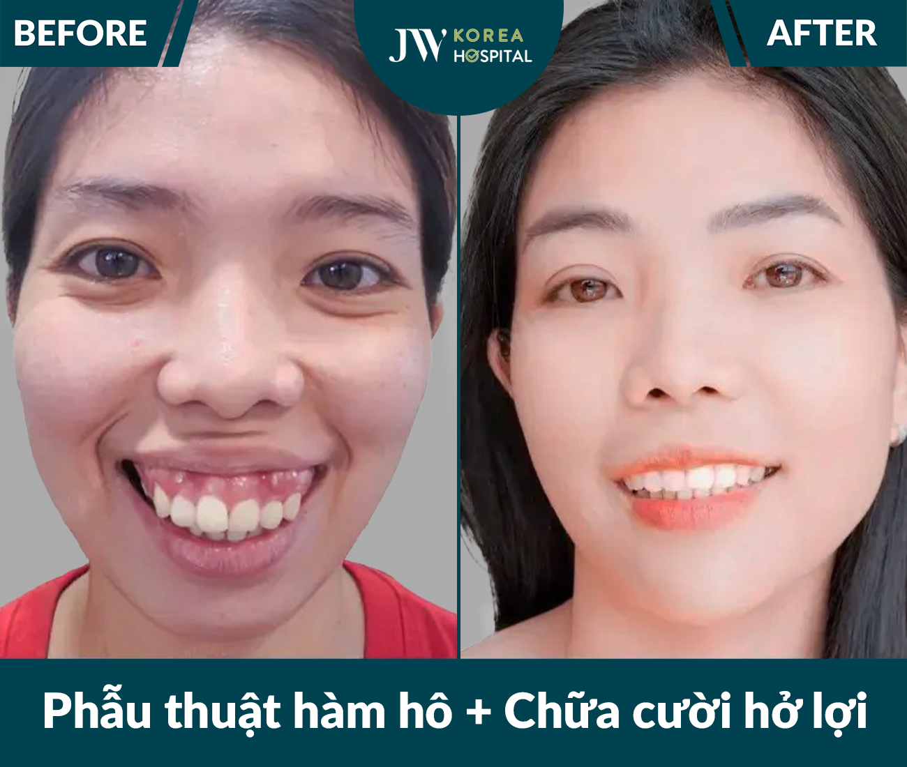 Phẫu thuật hàm hô