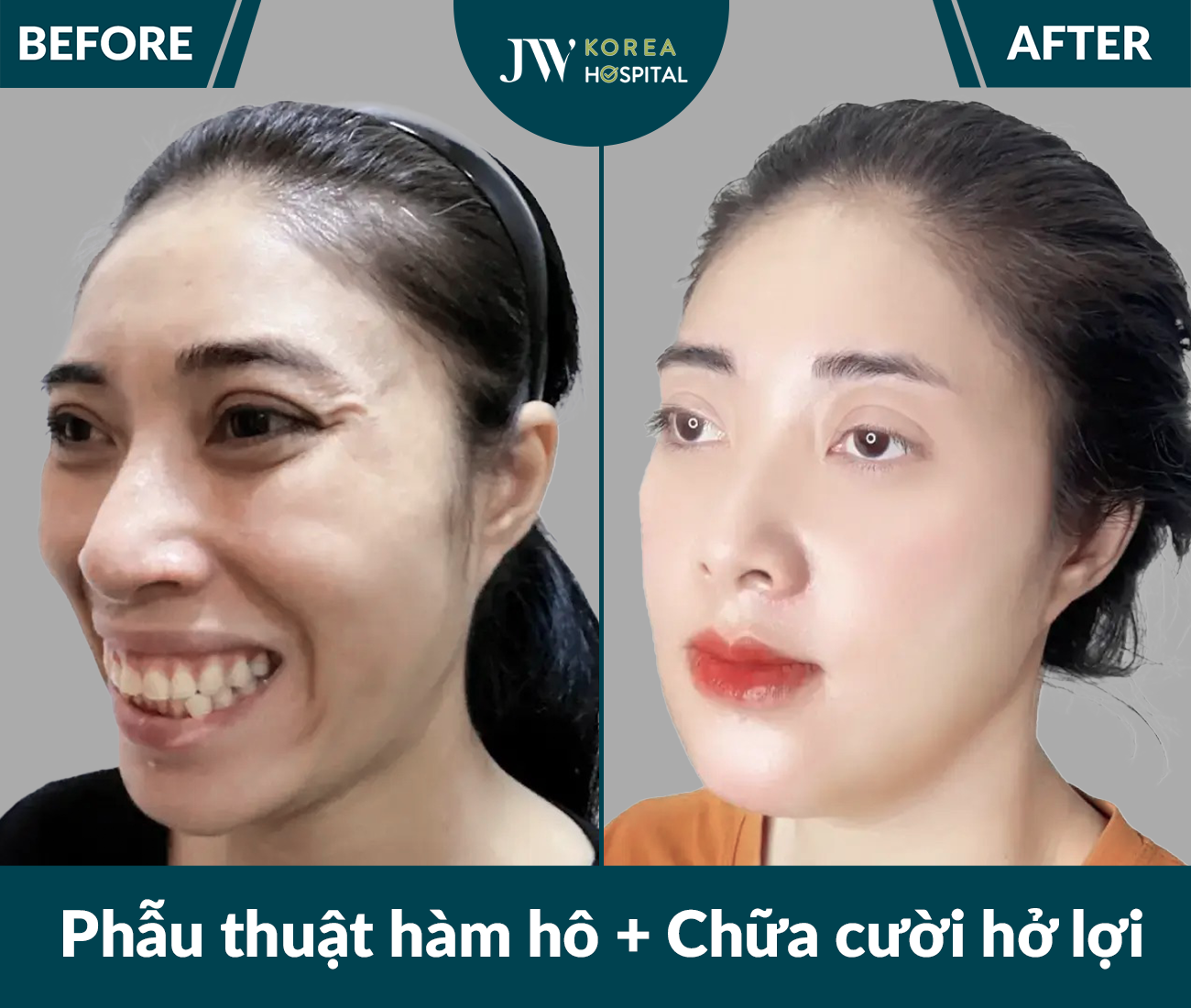 Phẫu thuật hàm hô