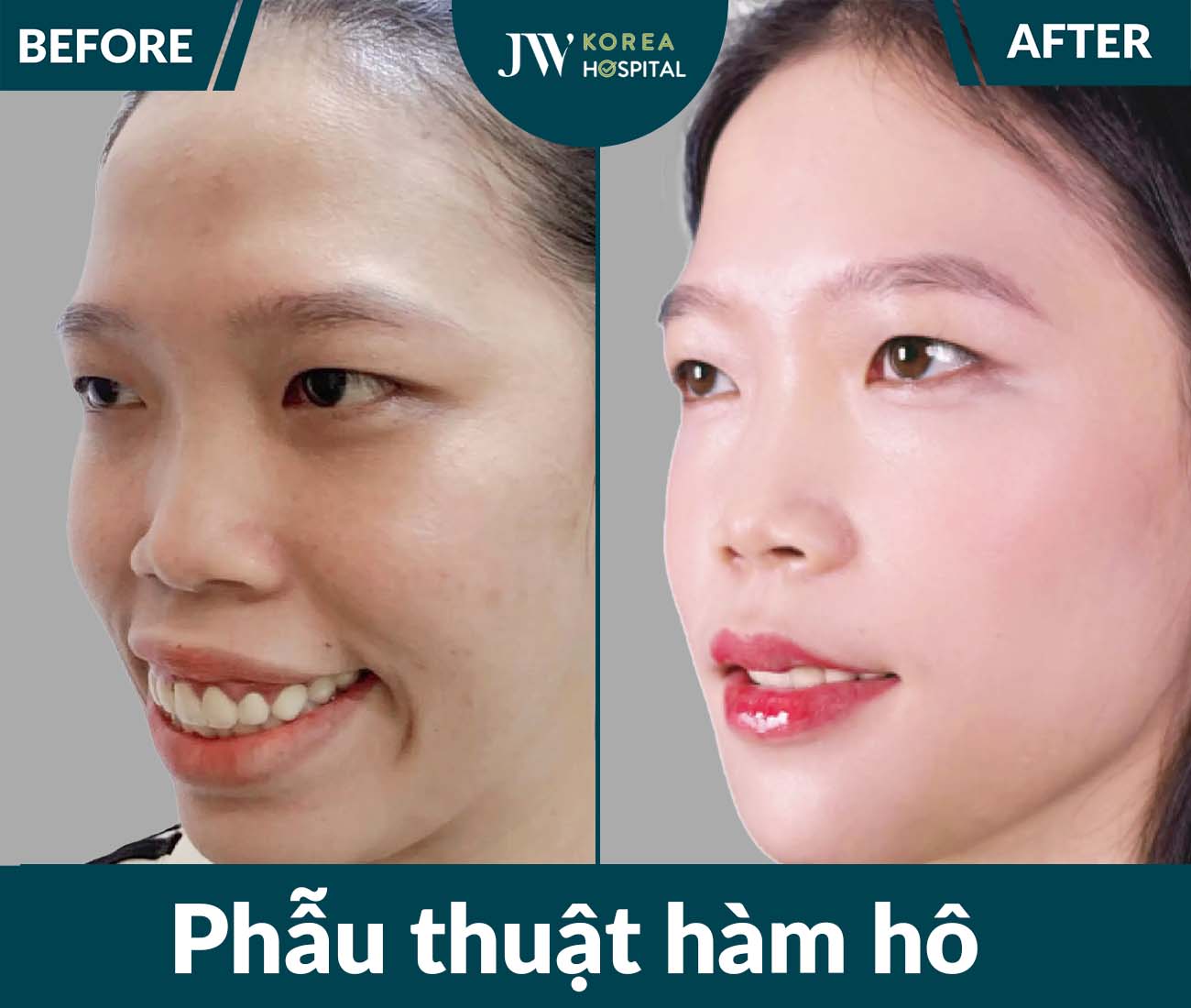 Phẫu thuật hàm hô