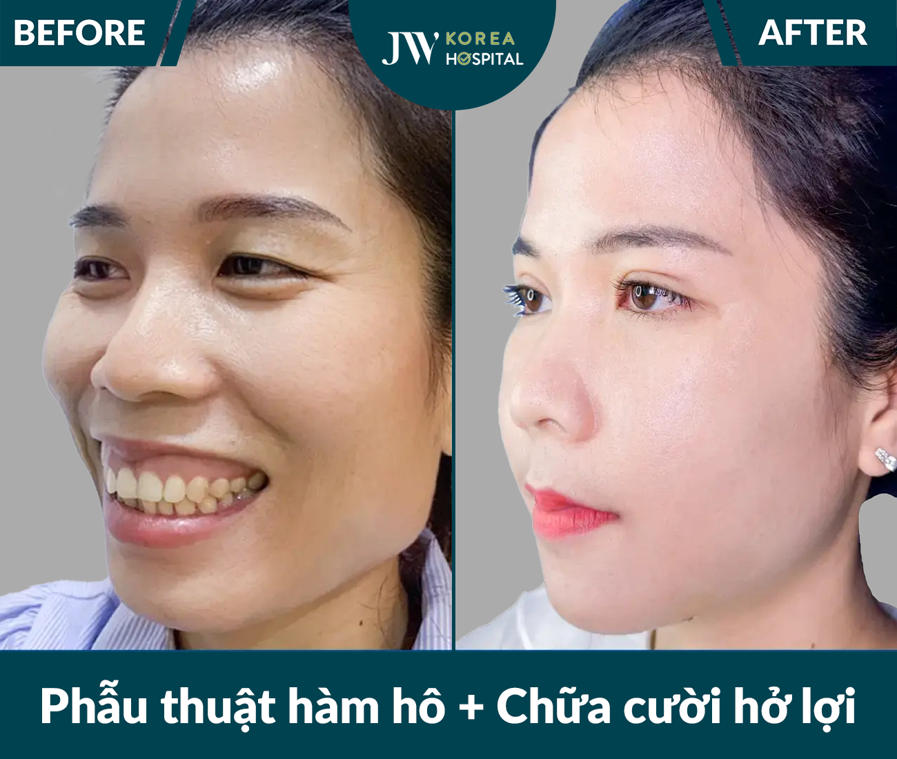 Phẫu thuật hàm hô