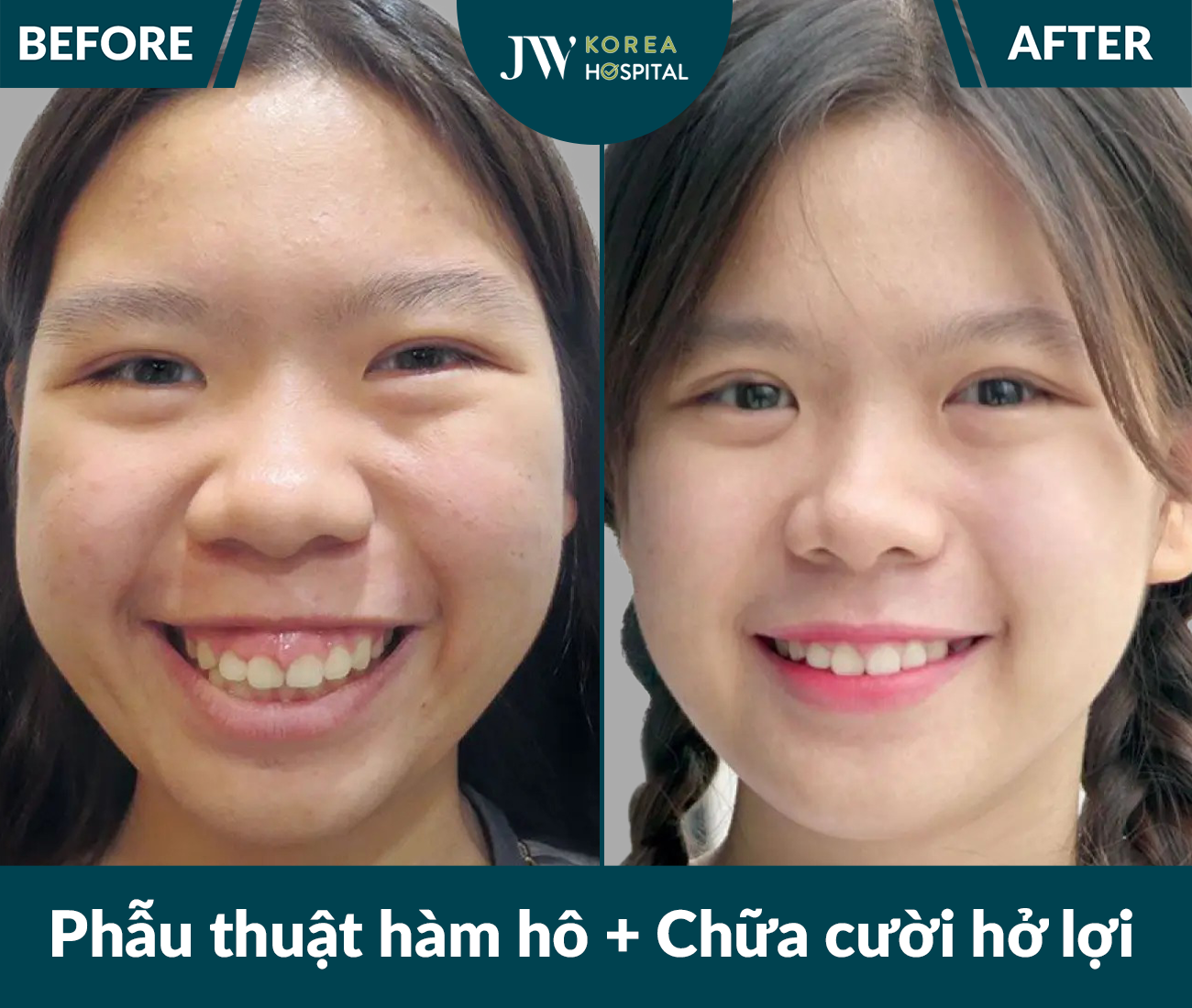 Phẫu thuật hàm hô