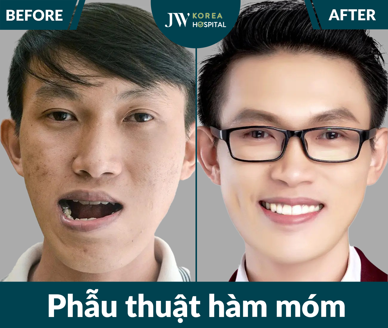 Phẫu thuật hàm móm