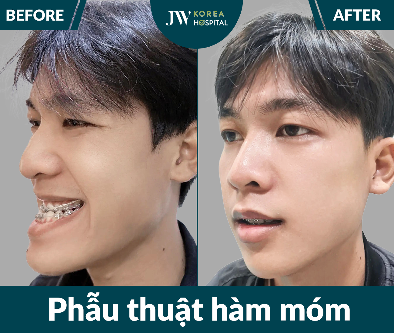 Phẫu thuật hàm móm