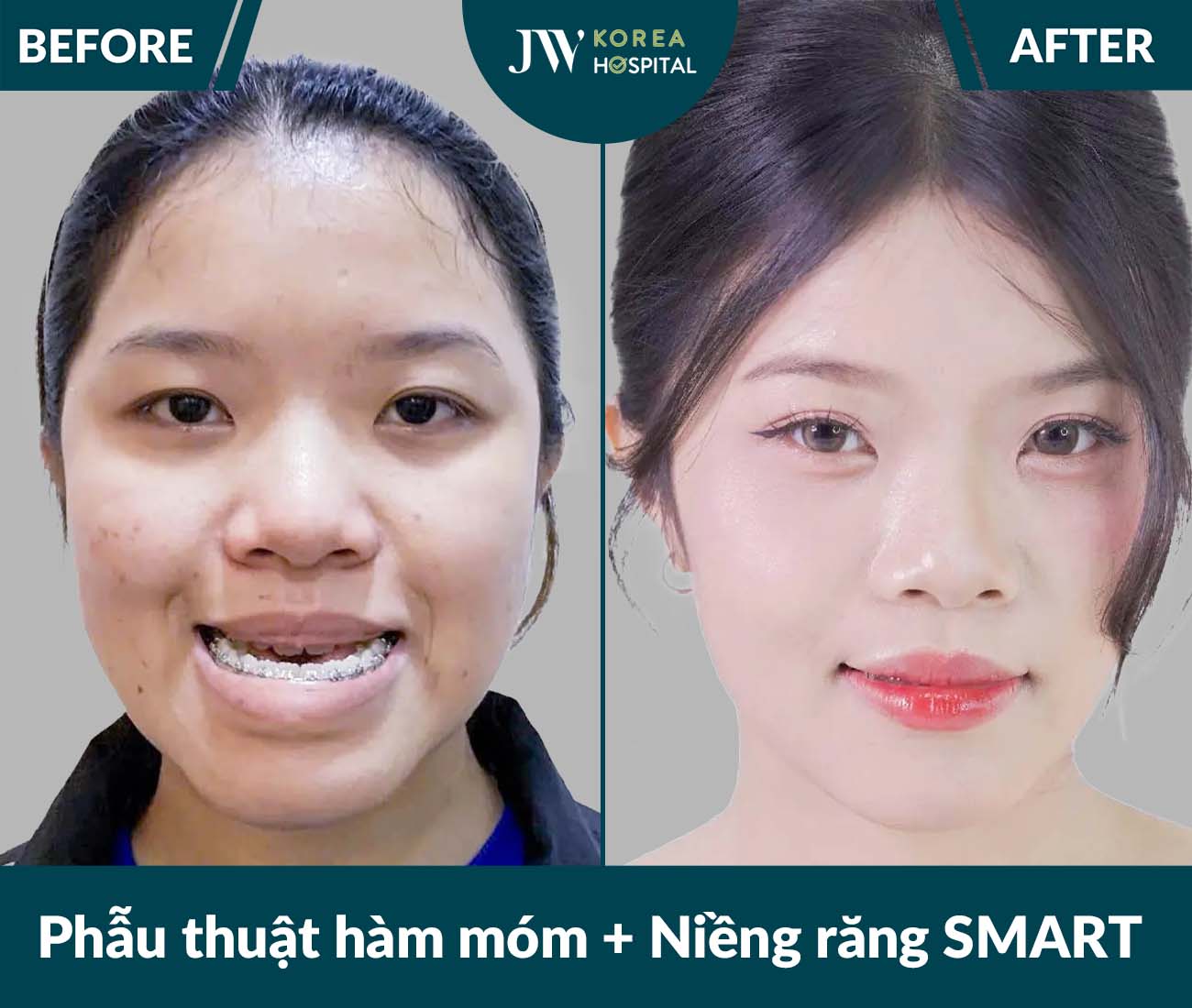 Phẫu thuật hàm móm