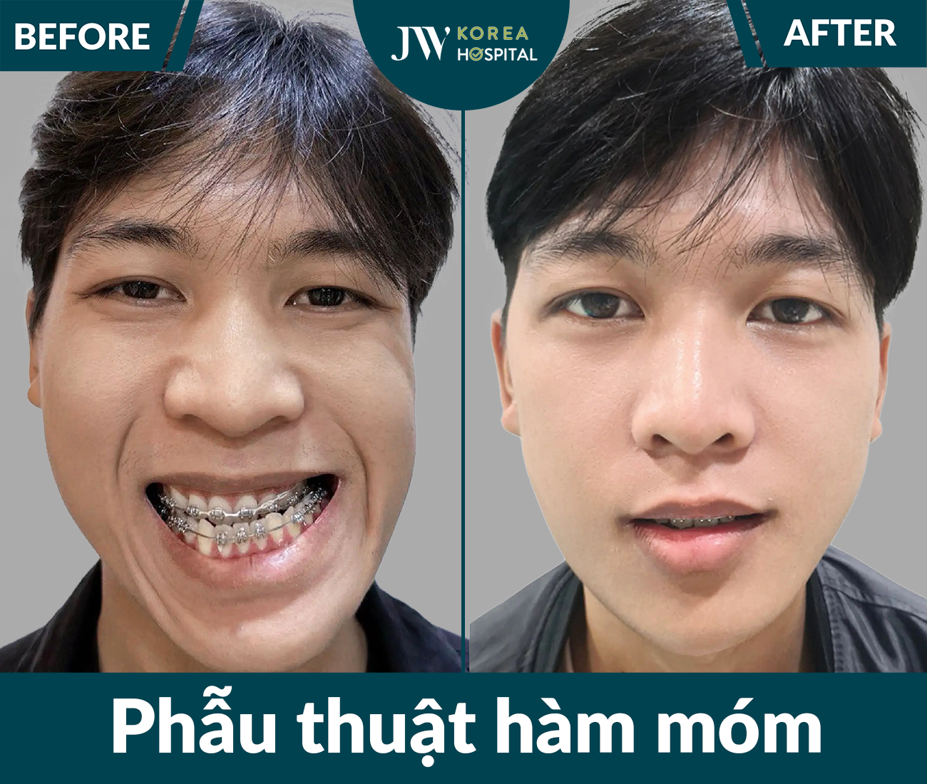 Phẫu thuật hàm móm