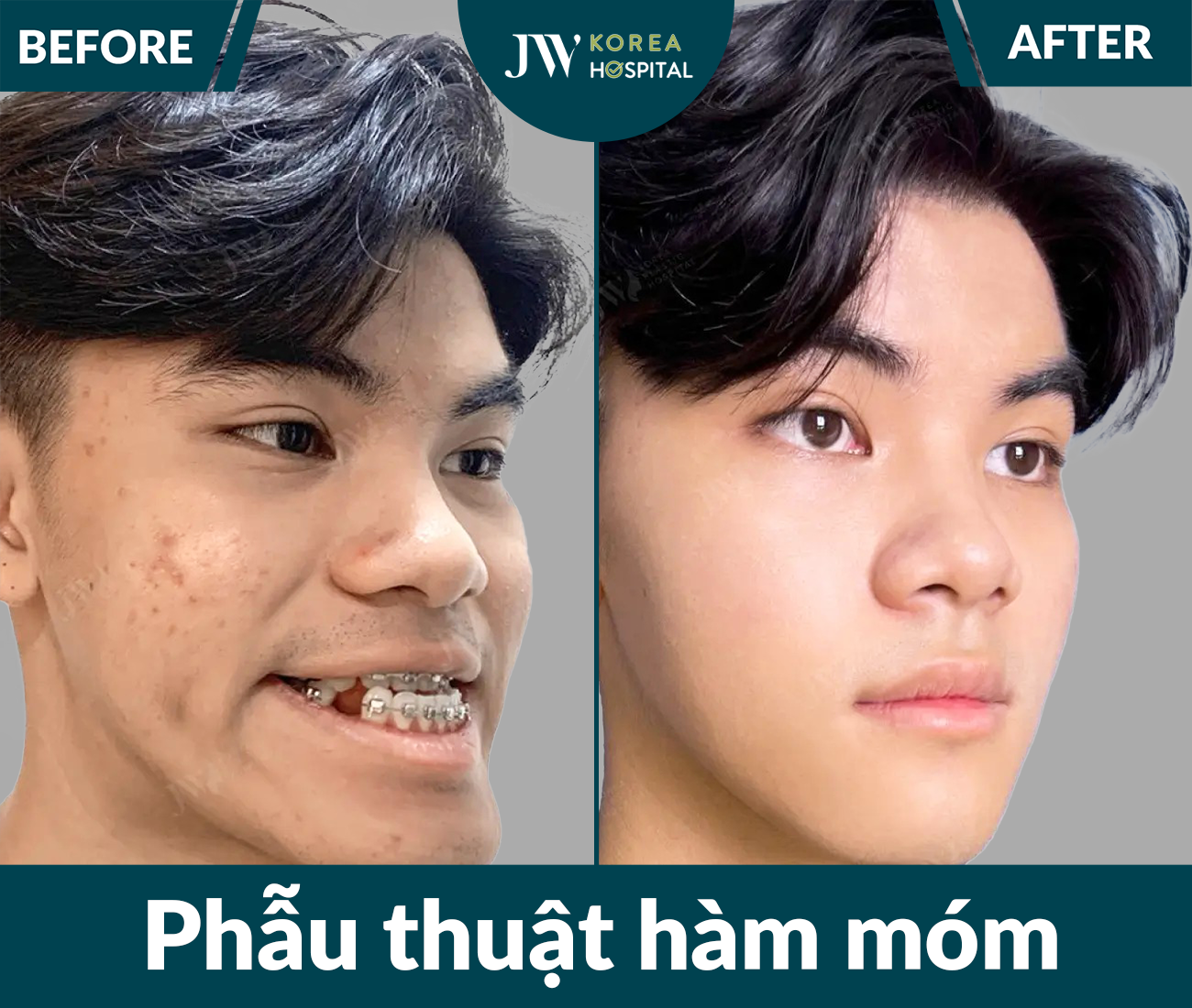 Phẫu thuật hàm móm