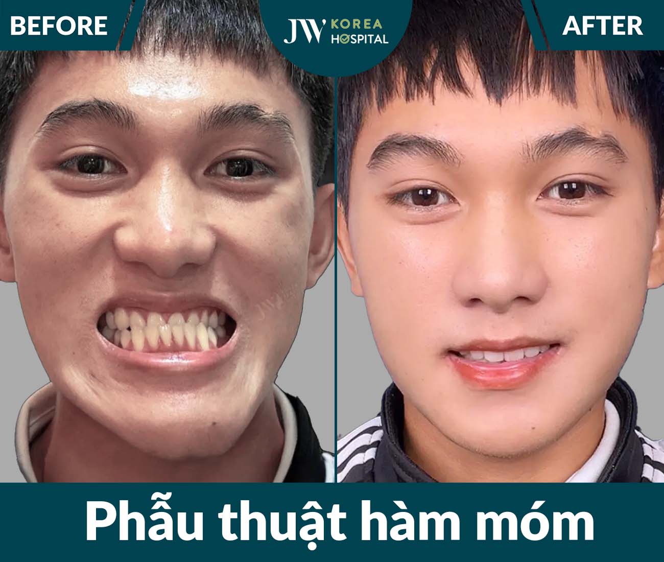 Phẫu thuật hàm móm