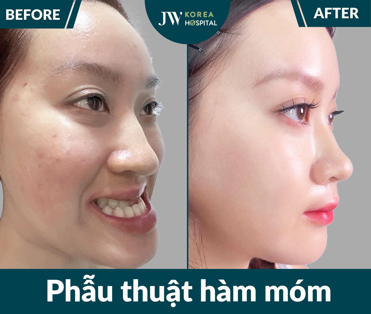 Phẫu thuật hàm móm