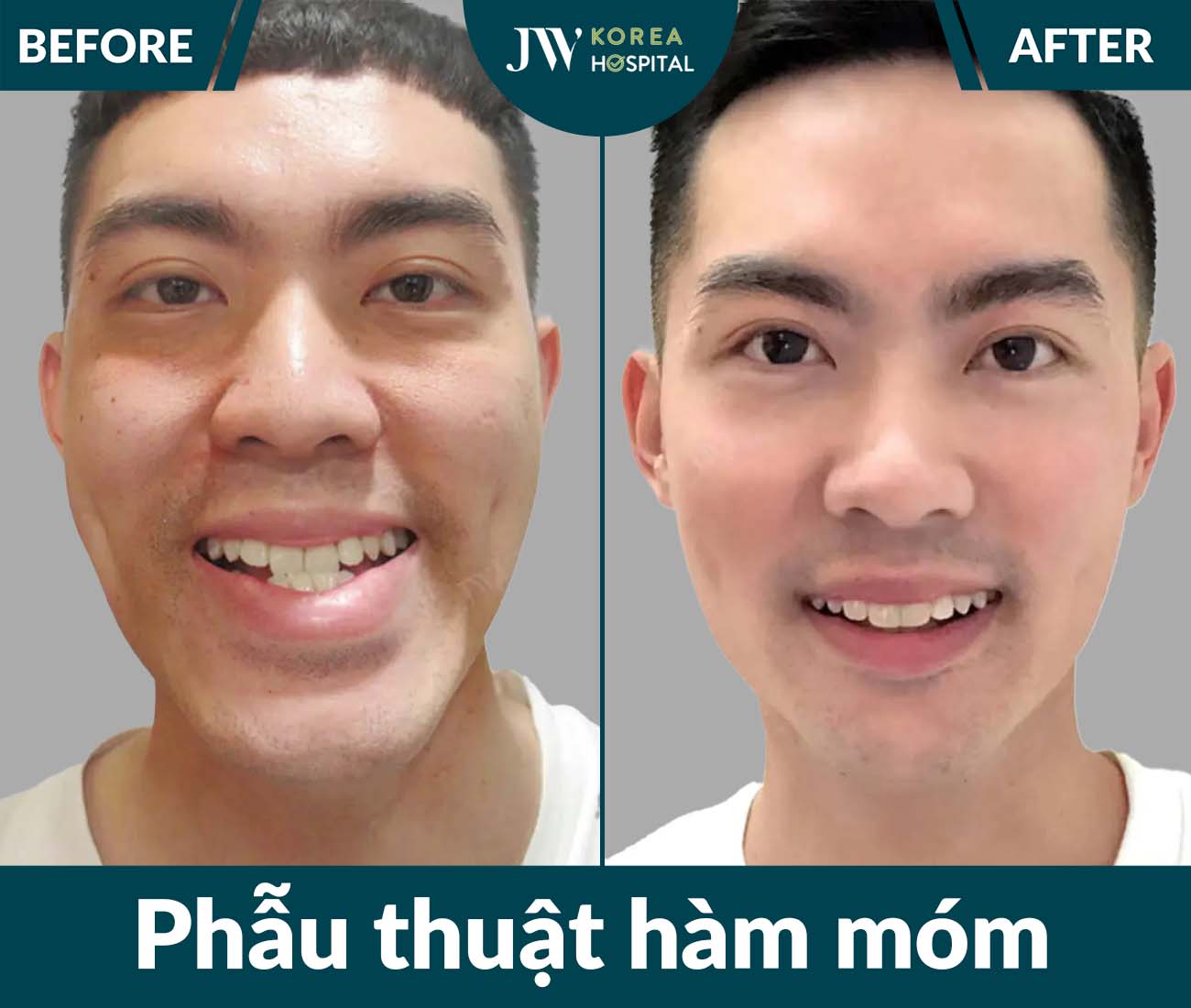 Phẫu thuật hàm móm