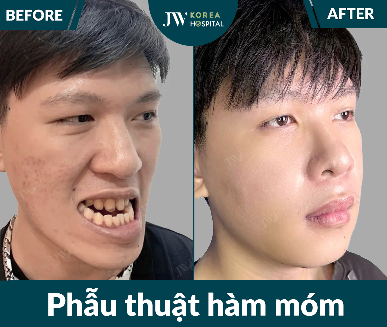 Phẫu thuật hàm móm