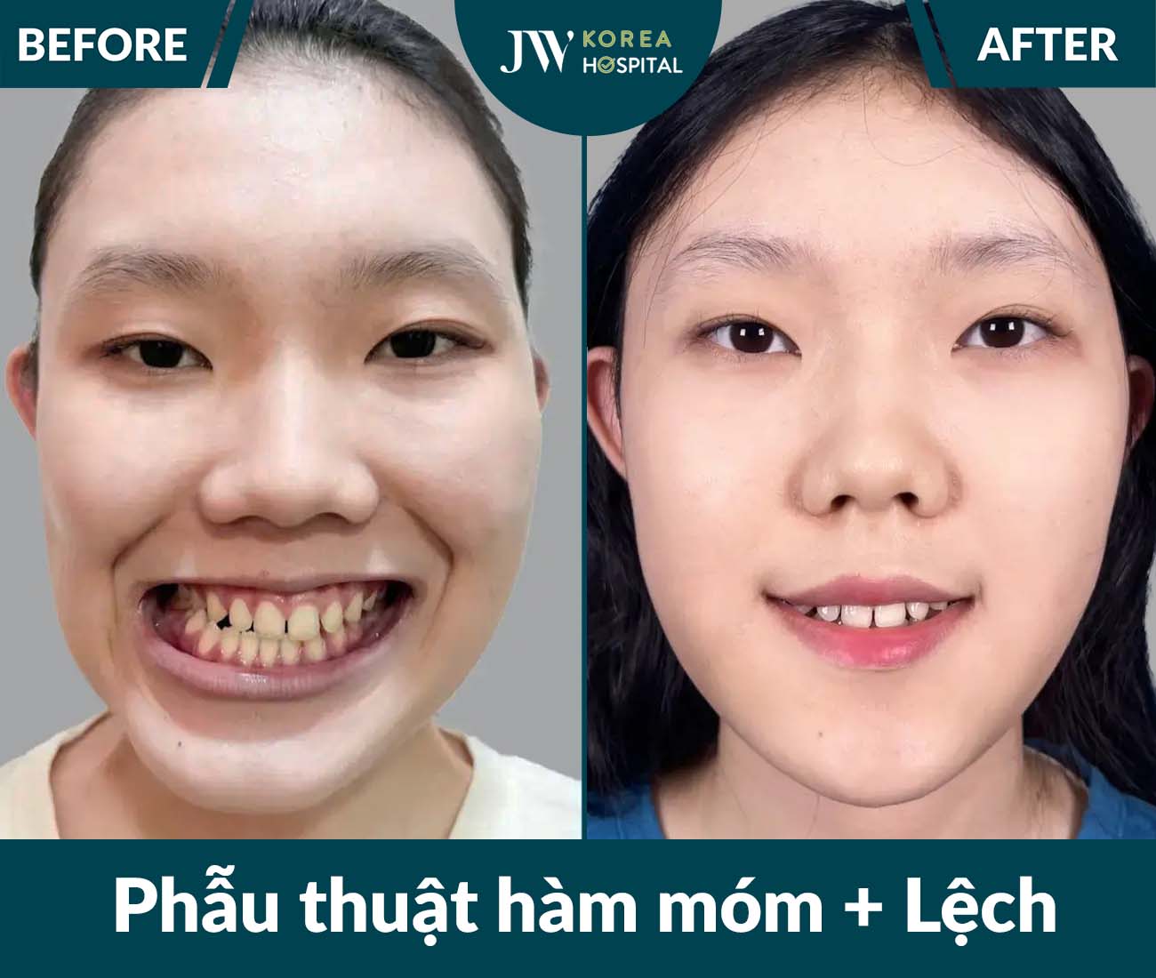Phẫu thuật hàm móm