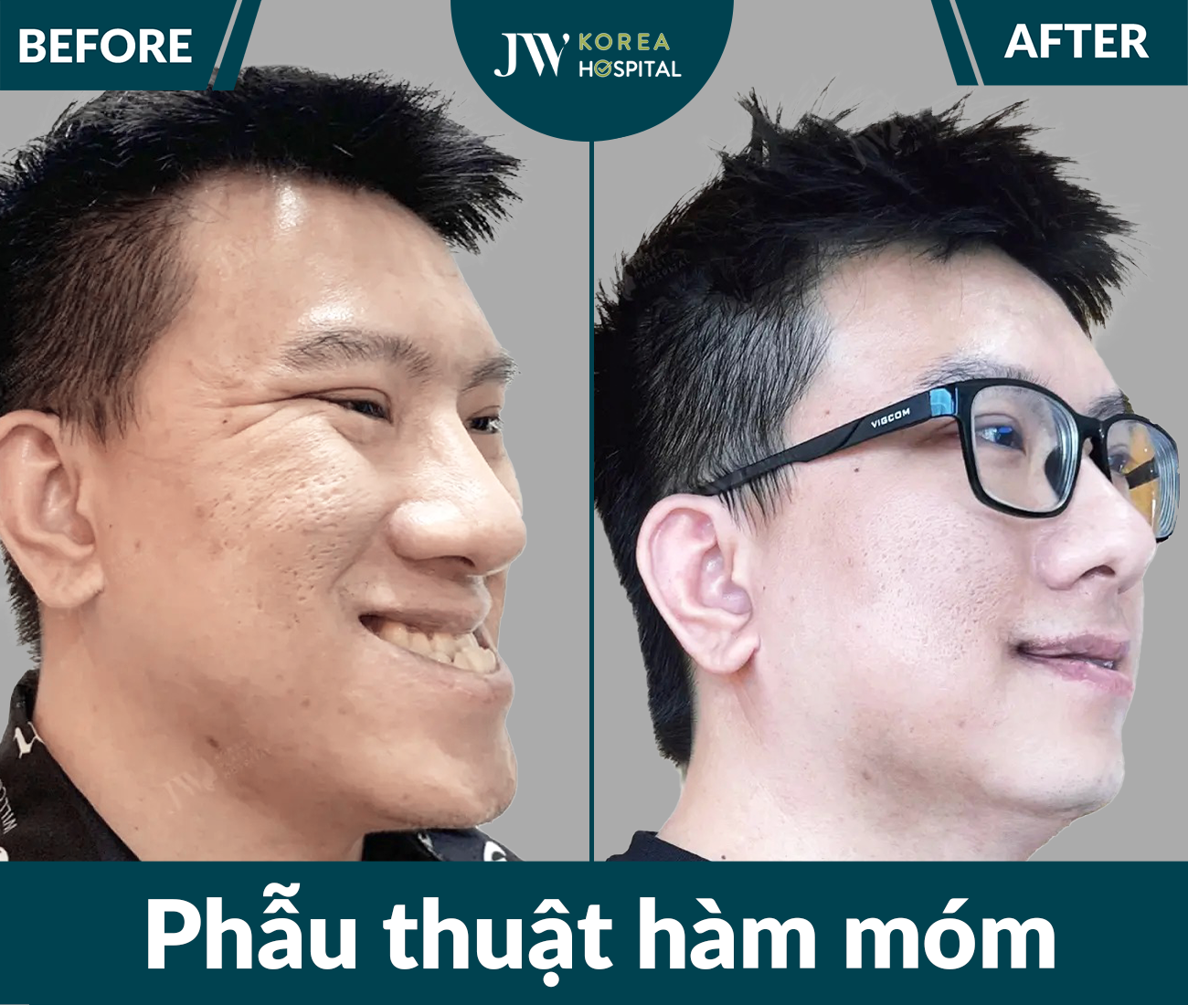 Phẫu thuật hàm móm