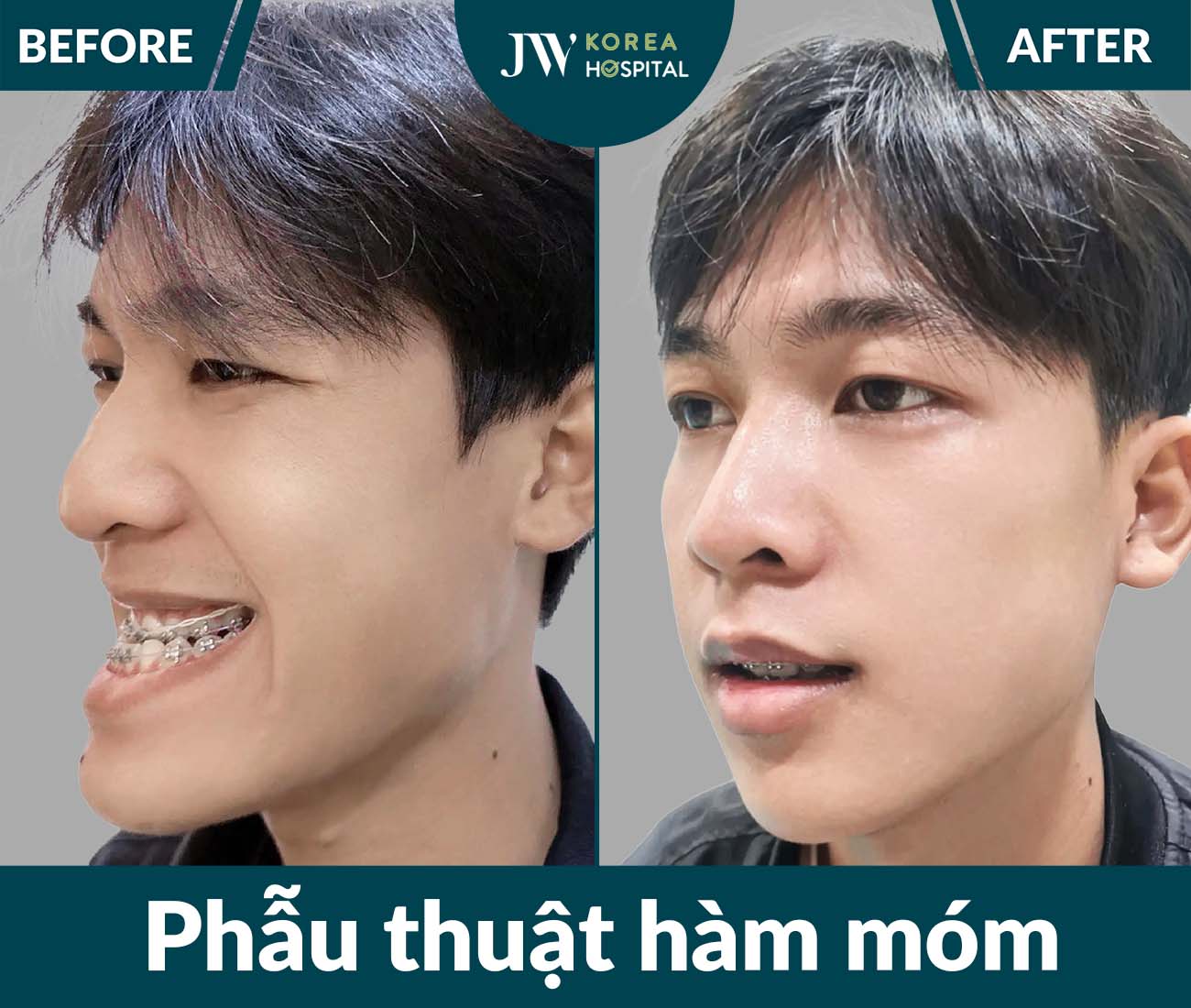 Phẫu thuật hàm móm