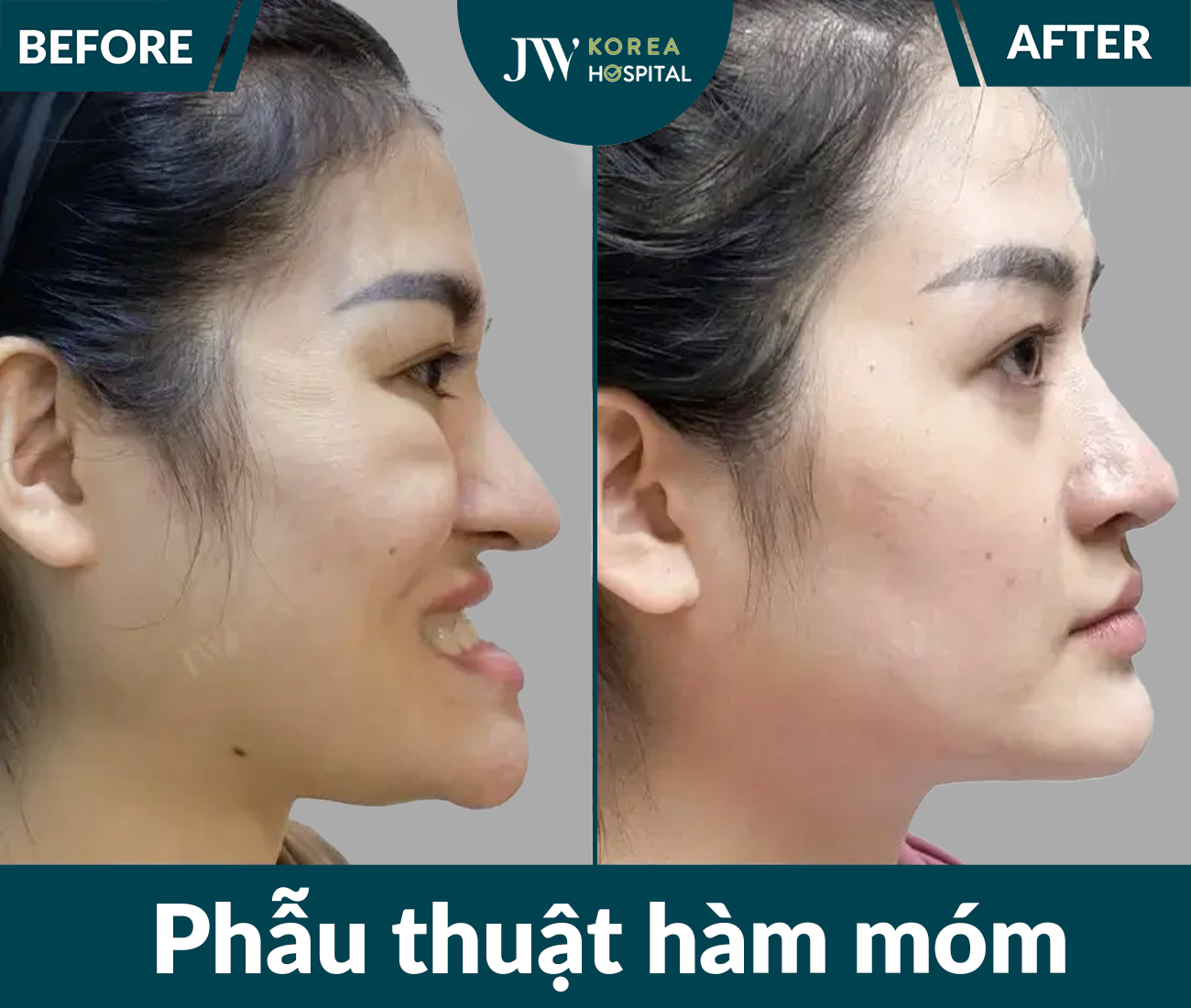 Phẫu thuật hàm móm