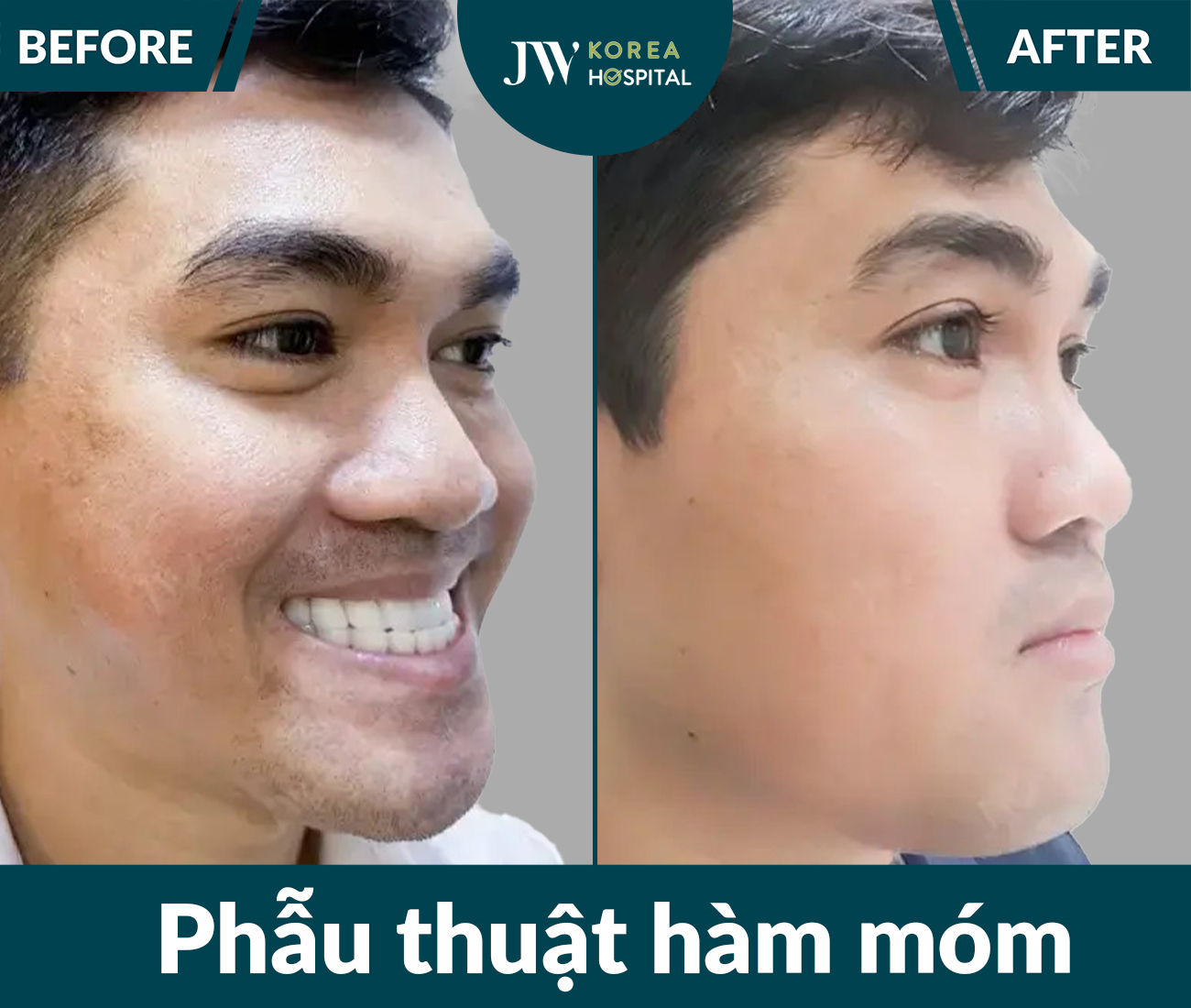 Phẫu thuật hàm móm