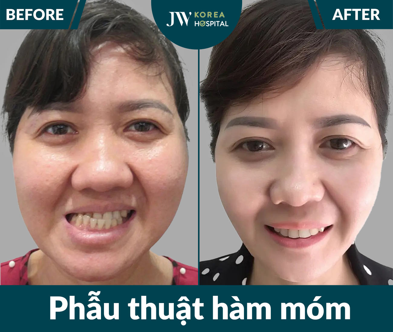 Phẫu thuật hàm móm