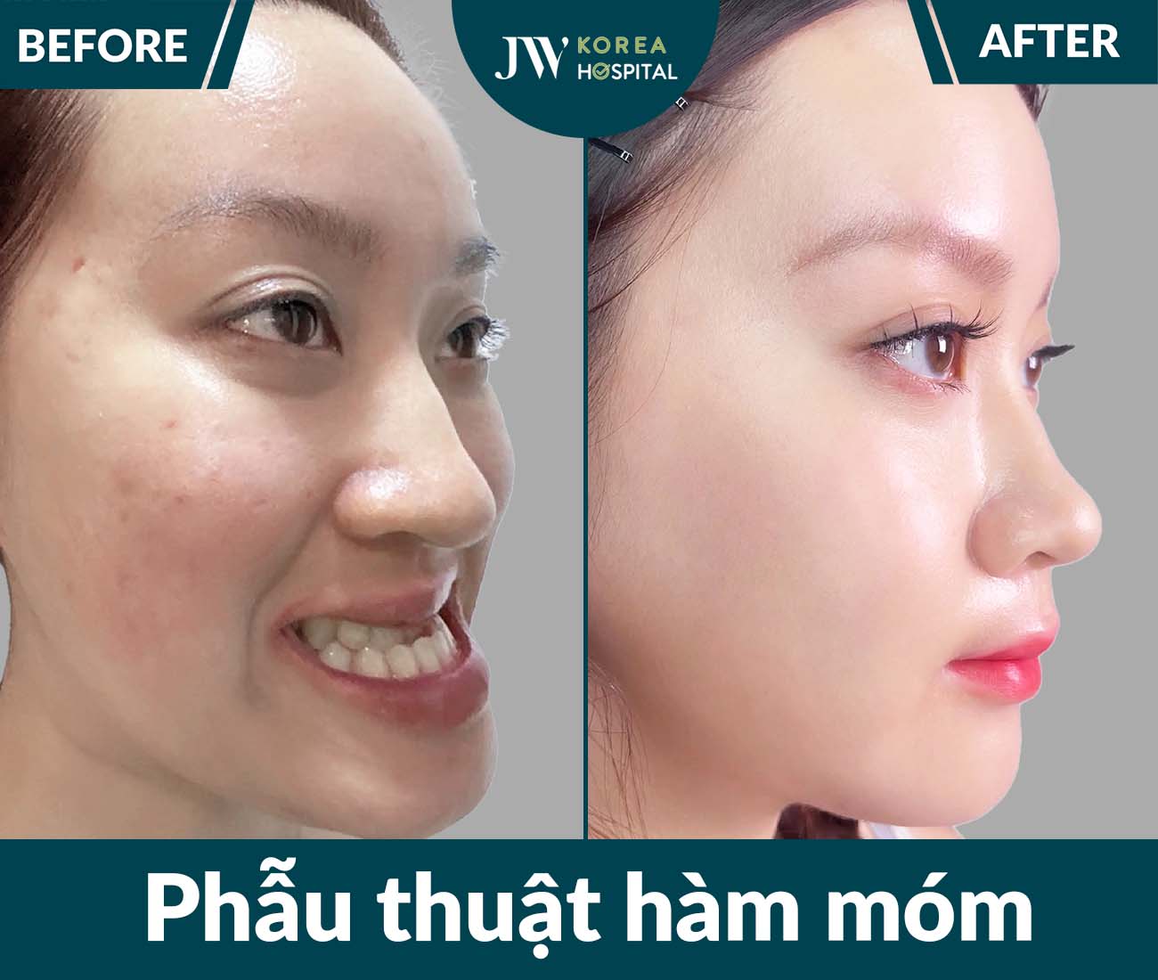 Phẫu thuật hàm móm