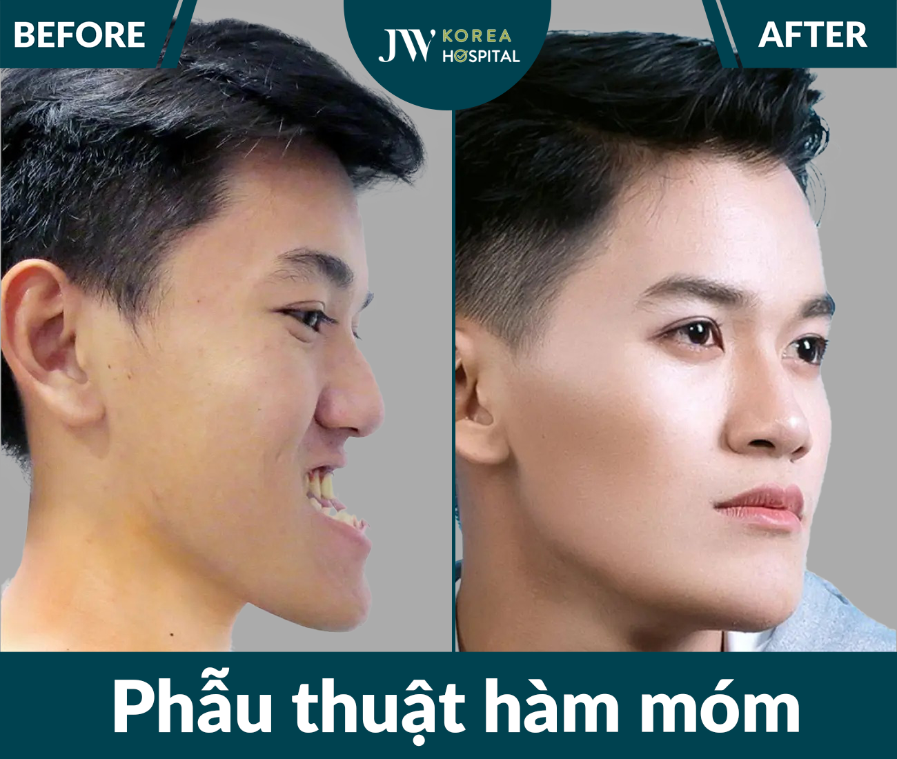Phẫu thuật hàm móm