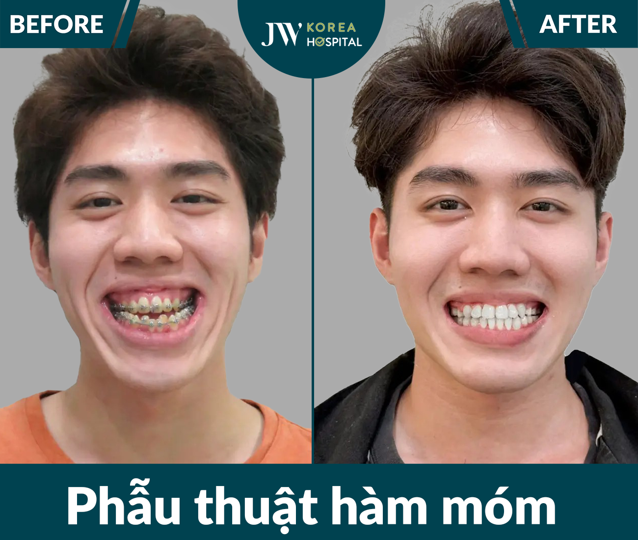 Phẫu thuật hàm móm