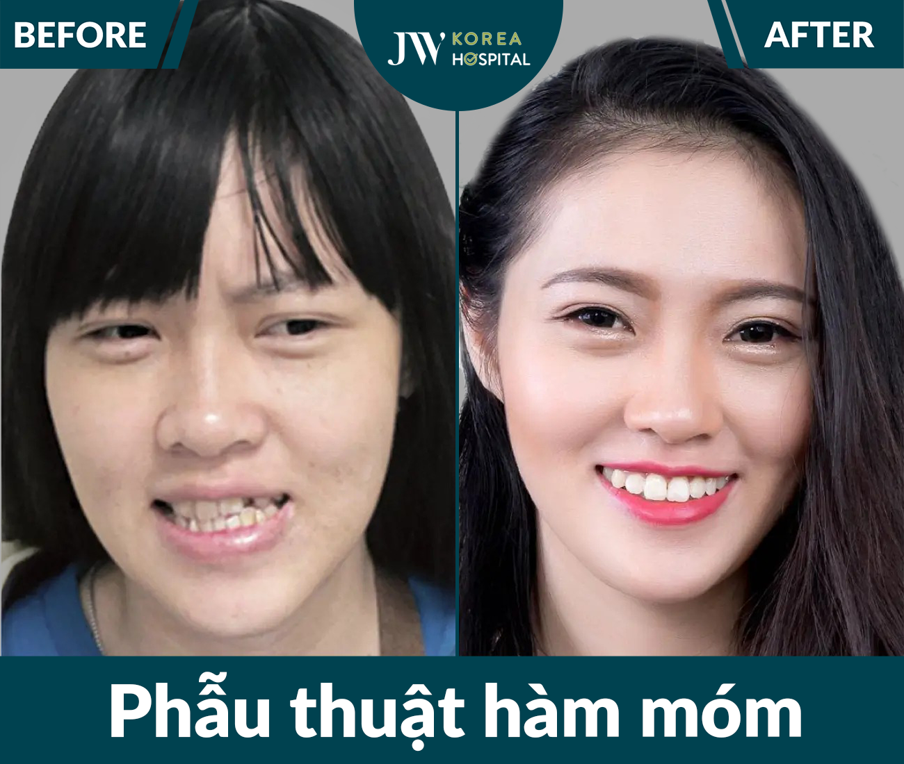 Phẫu thuật hàm móm