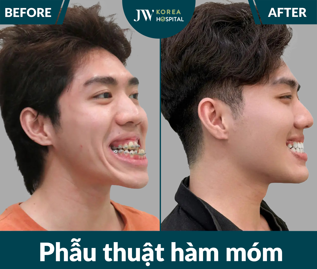 Phẫu thuật hàm móm