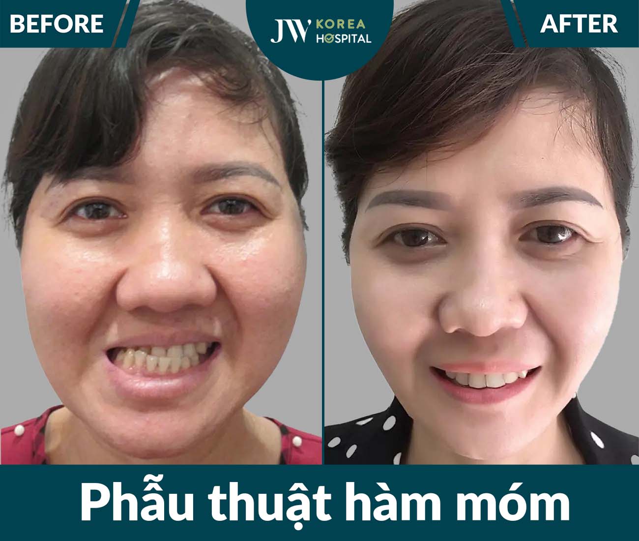 Phẫu thuật hàm móm