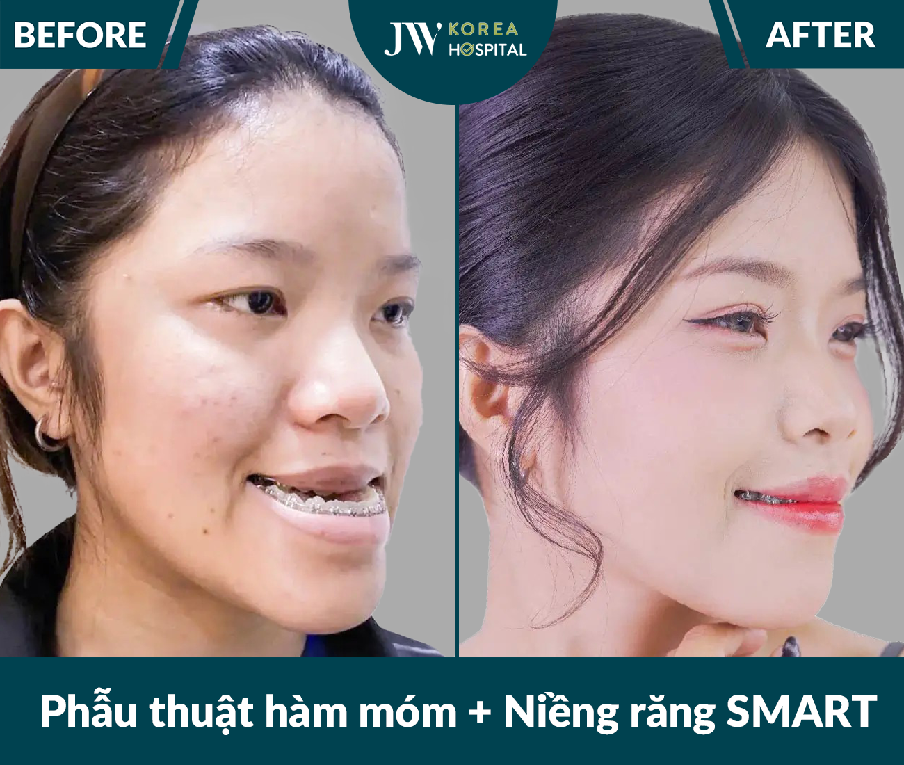 Phẫu thuật hàm móm