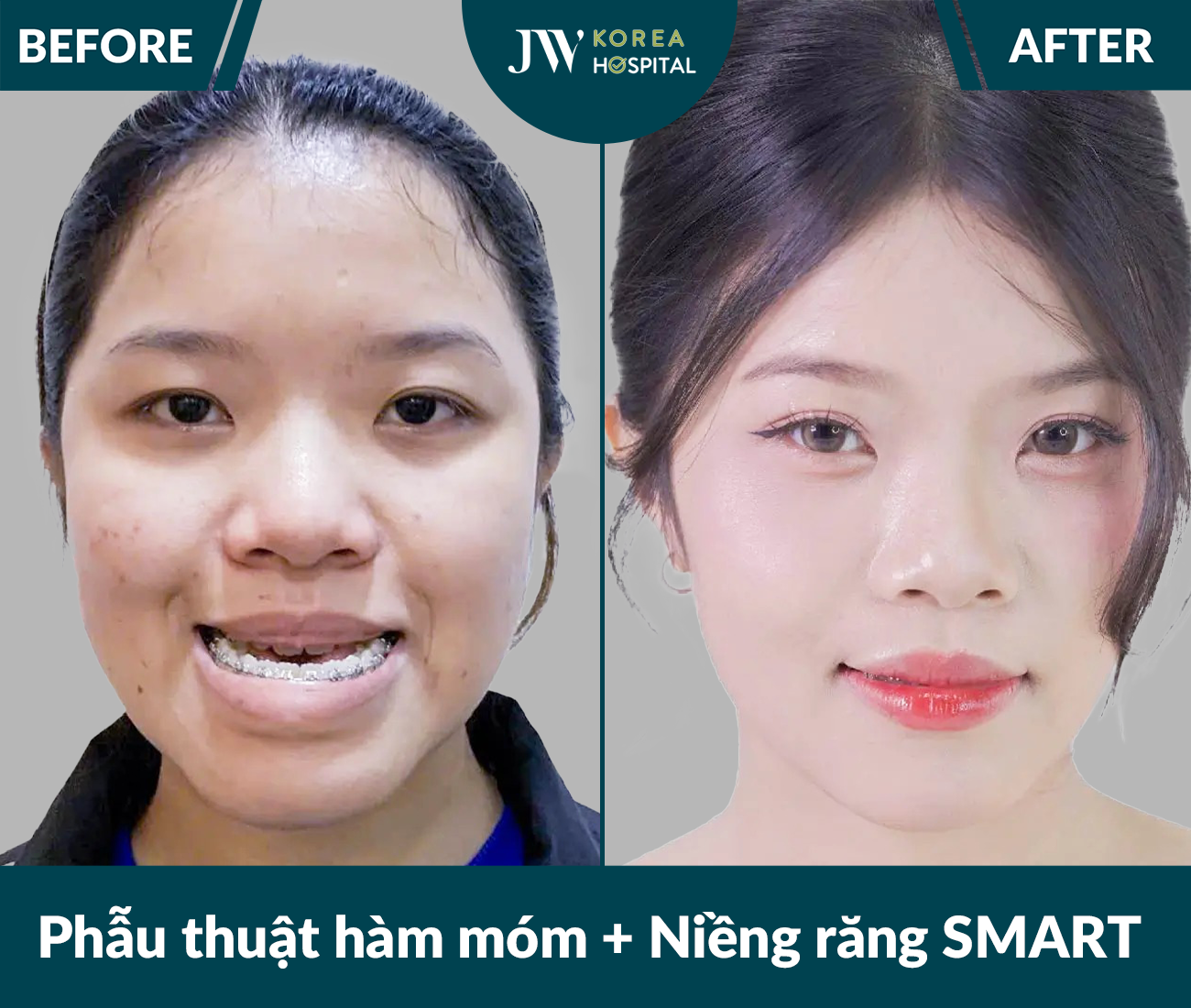 Phẫu thuật hàm móm