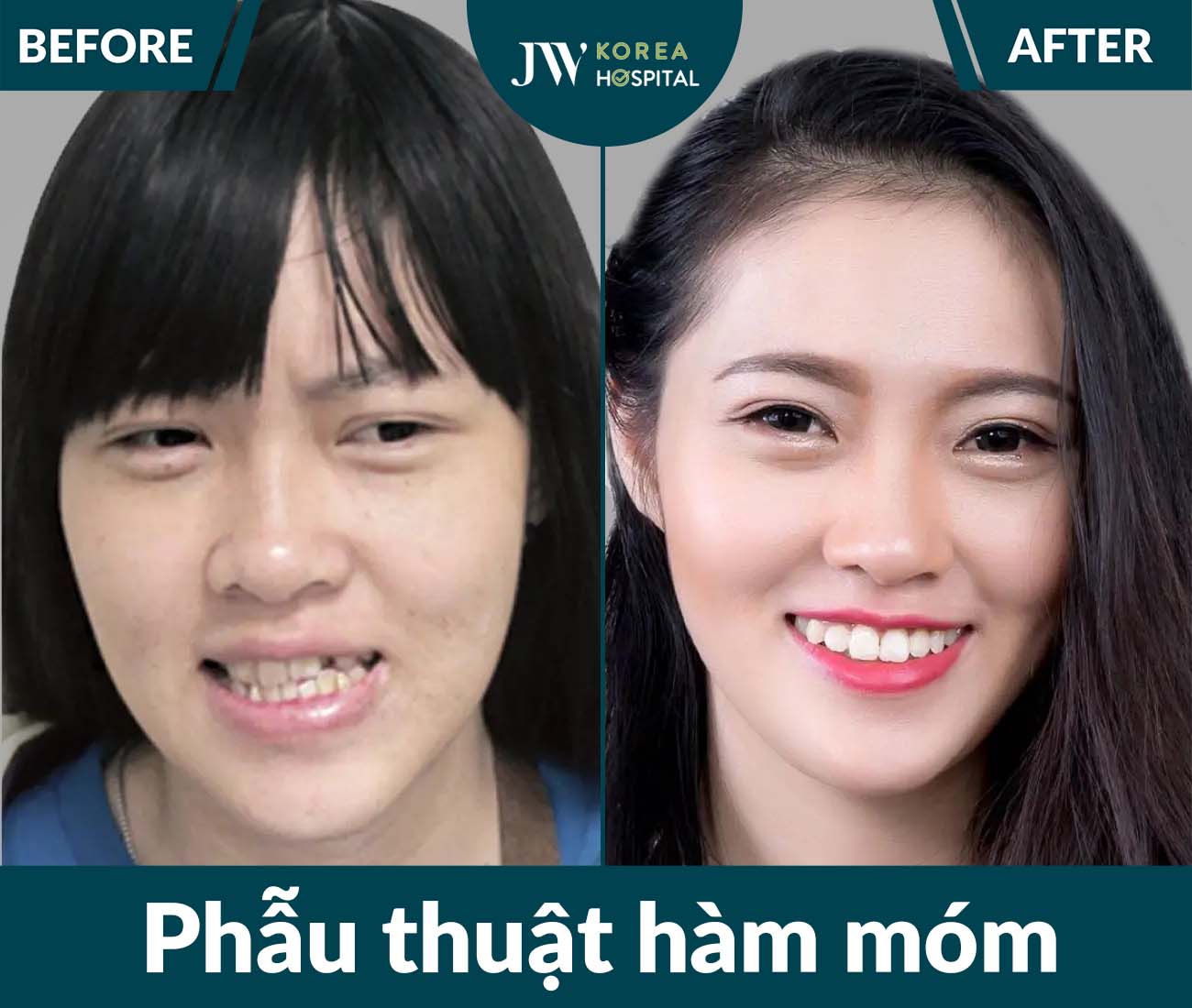 Phẫu thuật hàm móm