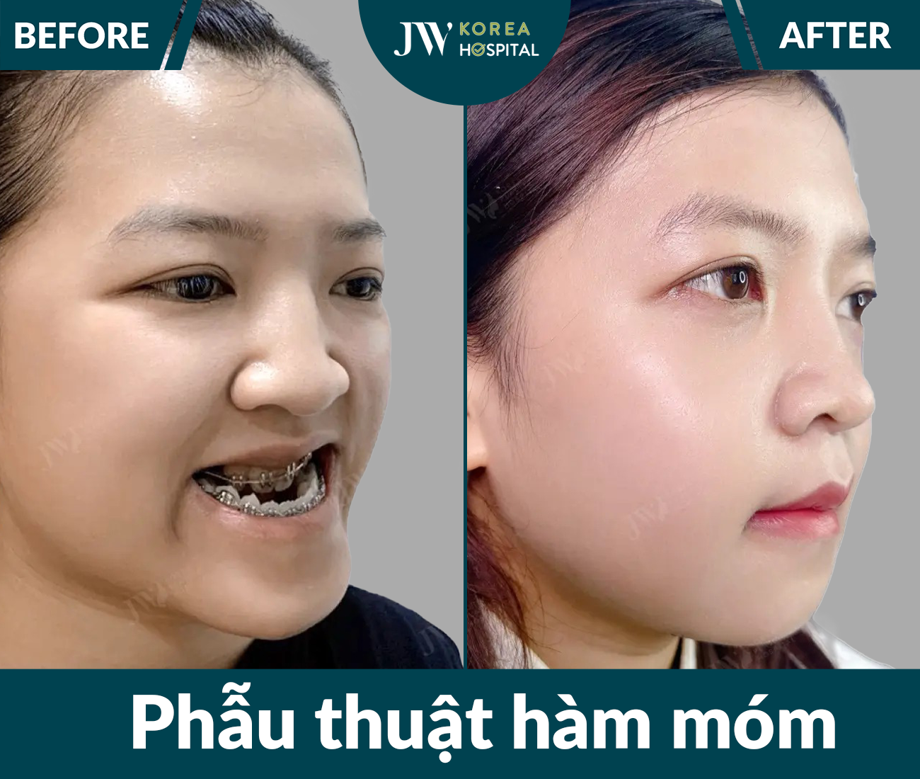 Phẫu thuật hàm móm