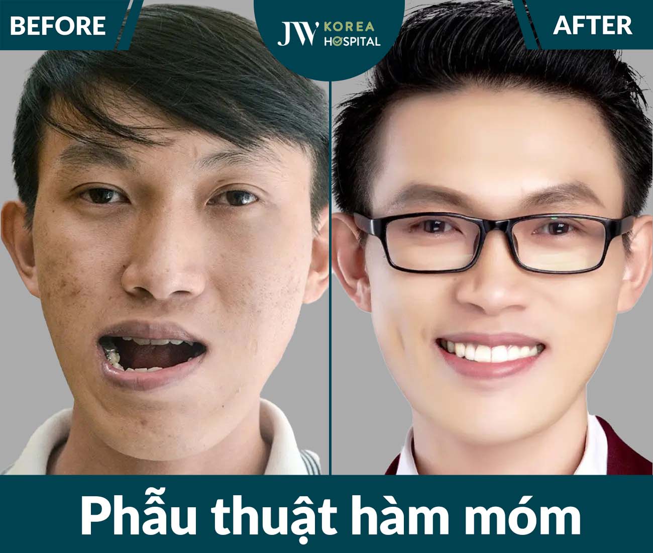 Phẫu thuật hàm móm