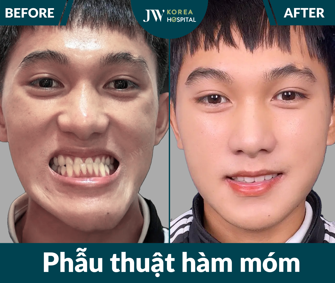 Phẫu thuật hàm móm