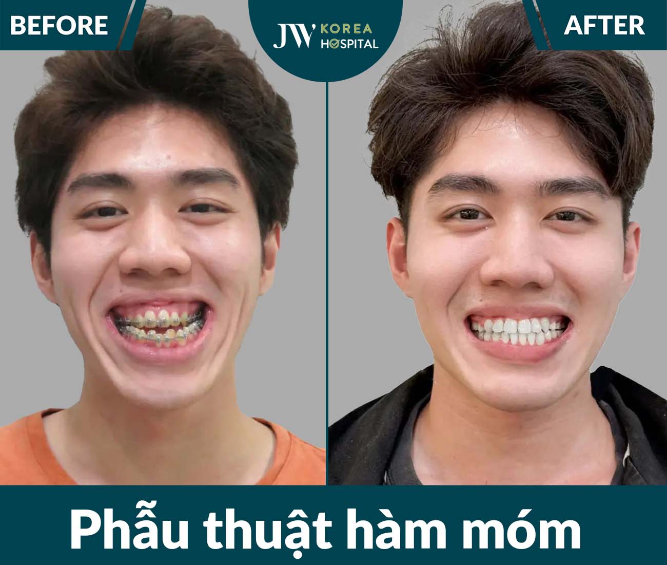 Phẫu thuật hàm móm