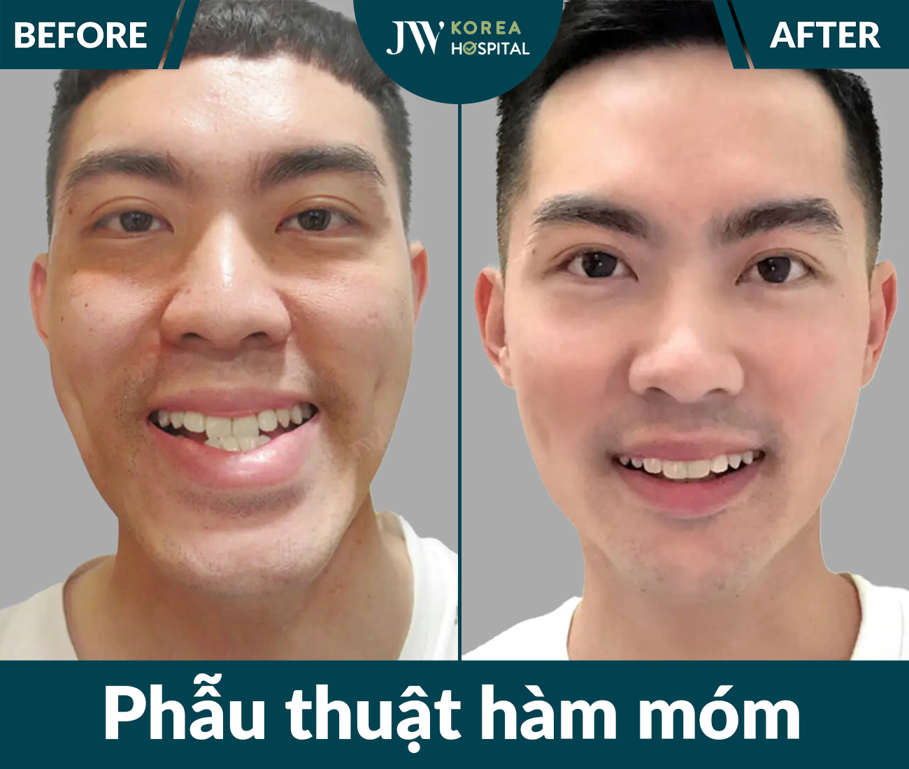 Phẫu thuật hàm móm