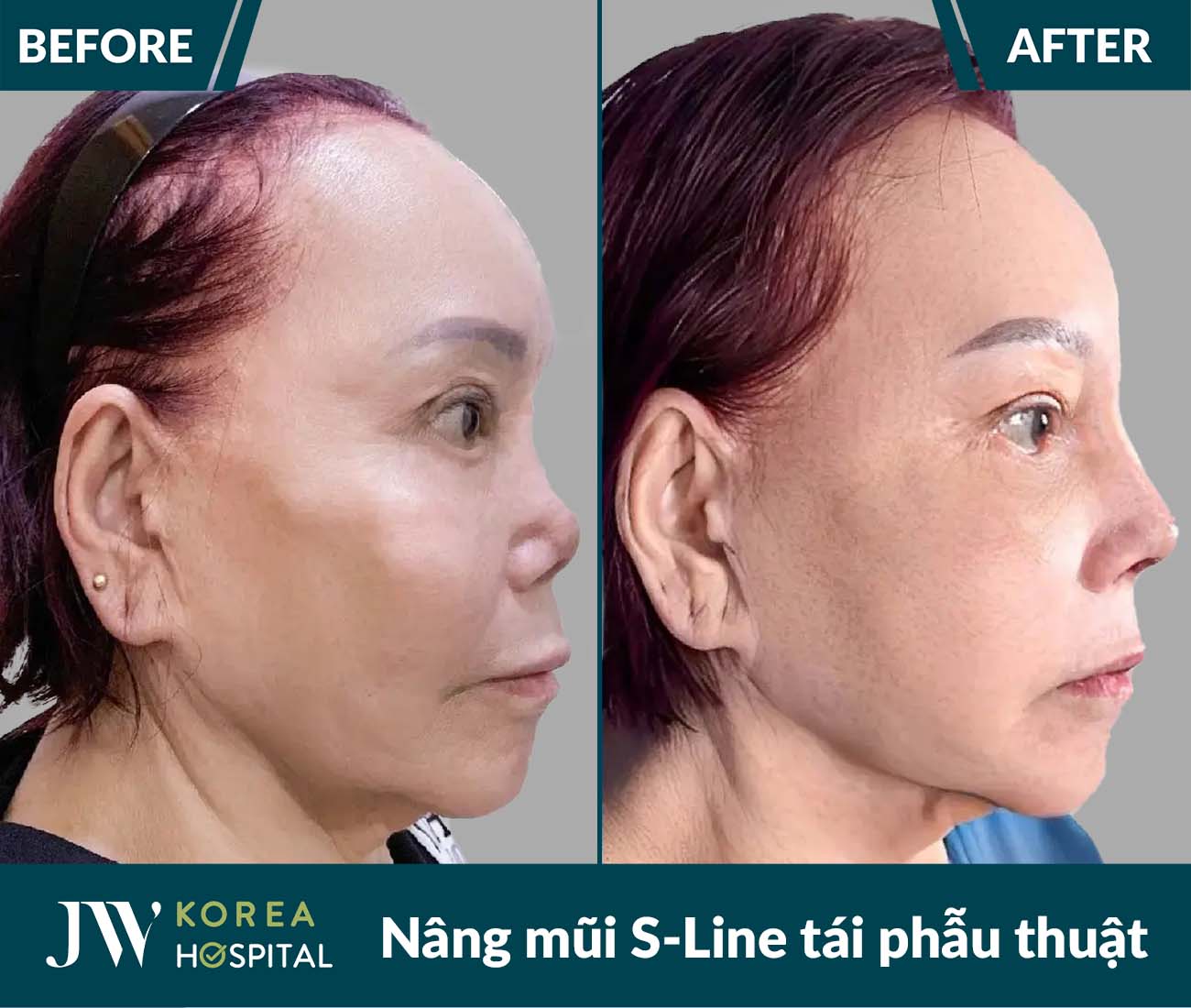Tái phẫu thuật mũi lỗi