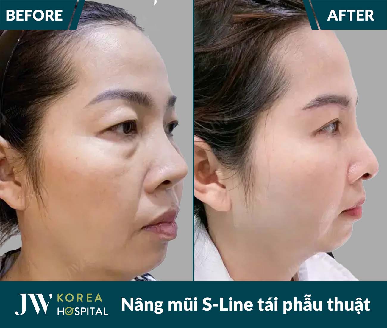 Tái phẫu thuật mũi lỗi