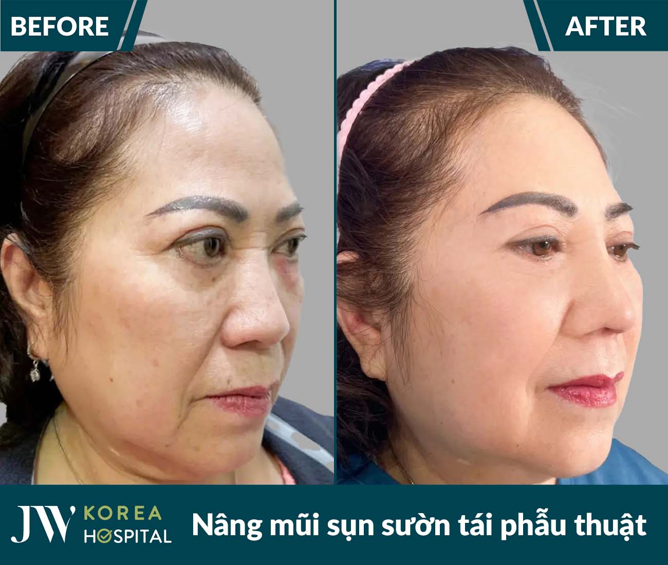 Tái phẫu thuật mũi lỗi