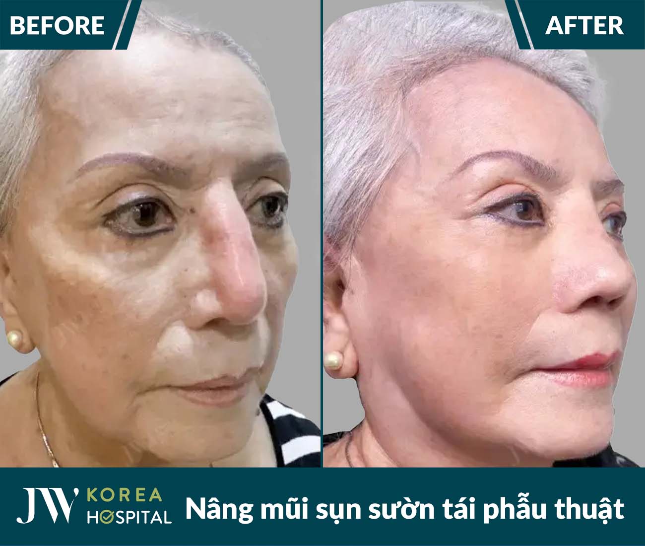 Tái phẫu thuật mũi lỗi