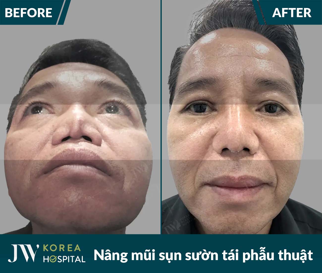 Tái phẫu thuật mũi lỗi