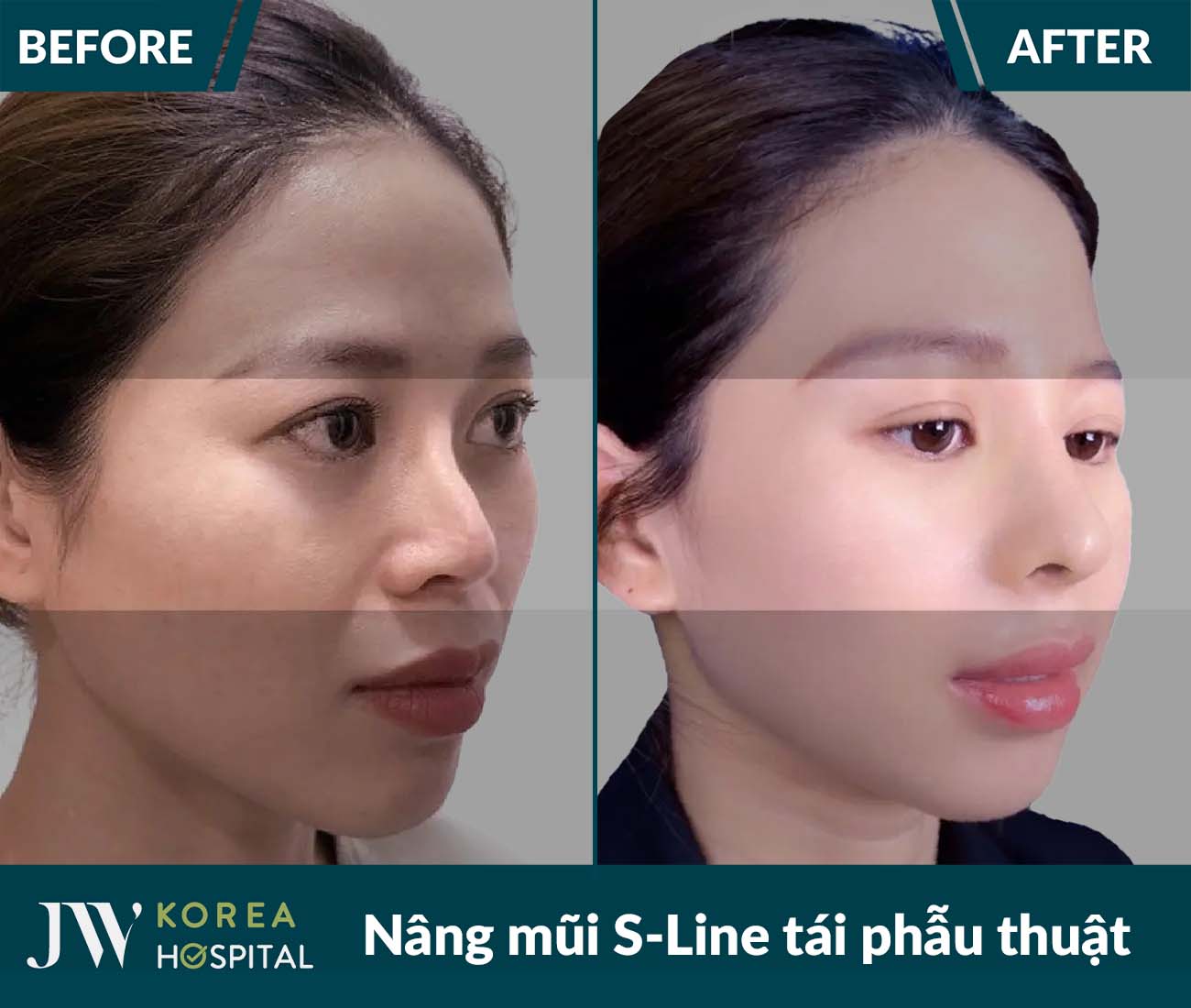 Tái phẫu thuật mũi lỗi