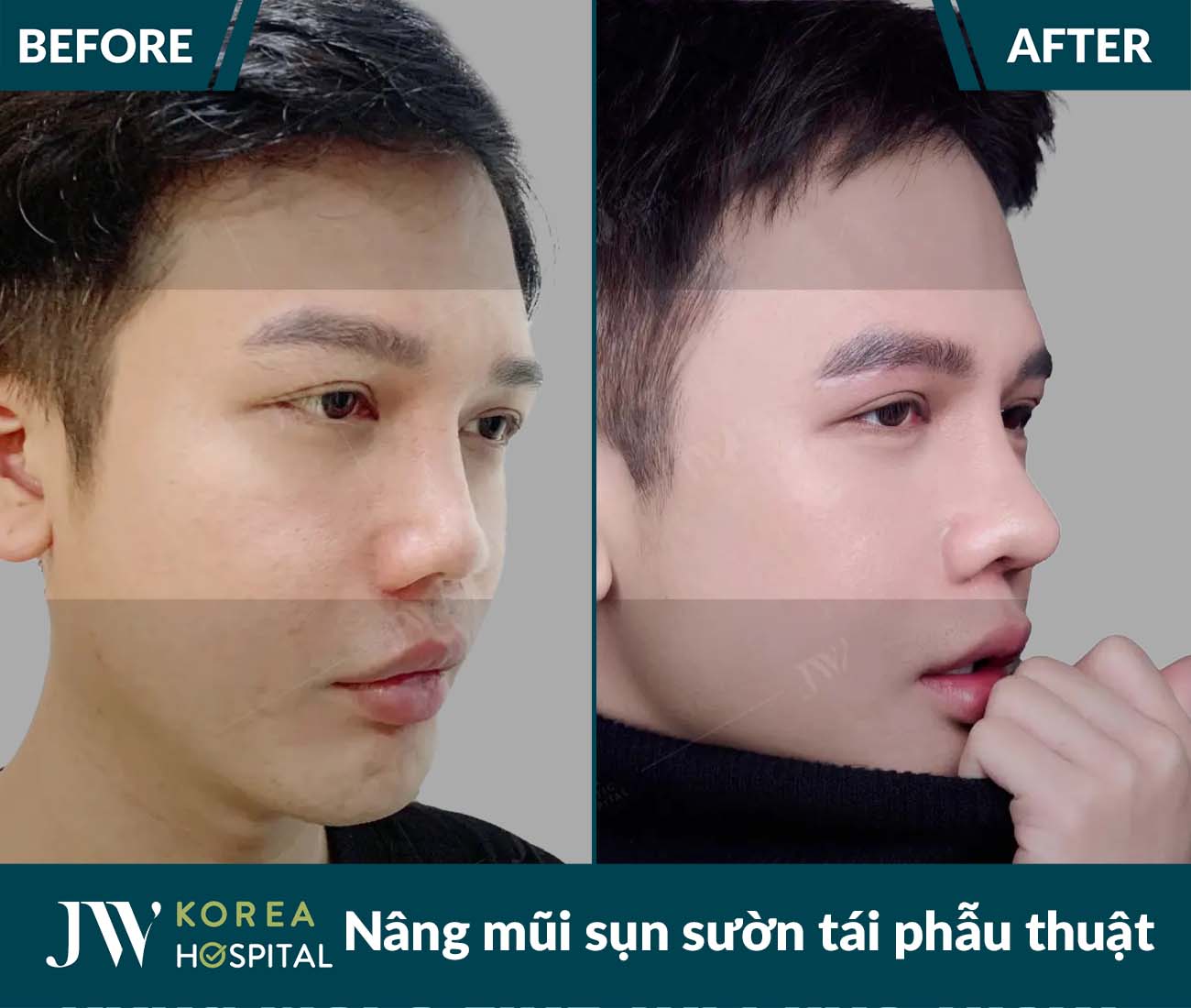 Tái phẫu thuật mũi lỗi