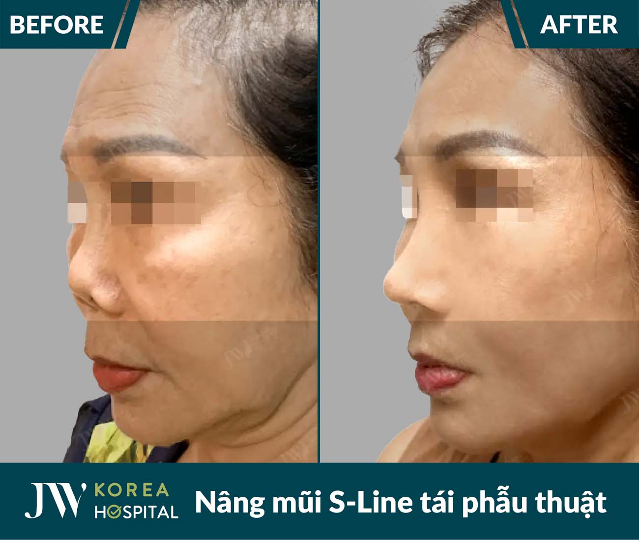 Tái phẫu thuật mũi lỗi