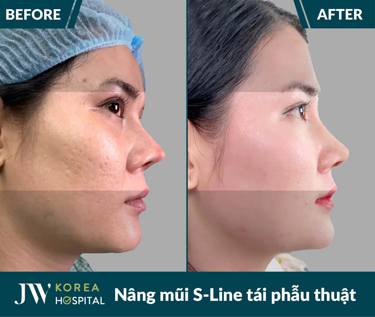 Tái phẫu thuật mũi lỗi