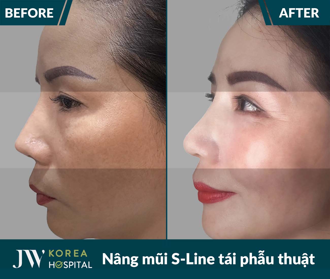 Tái phẫu thuật mũi lỗi