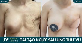 Bệnh viện JW tái tạo vòng 1 cho bệnh nhân ung thư vú