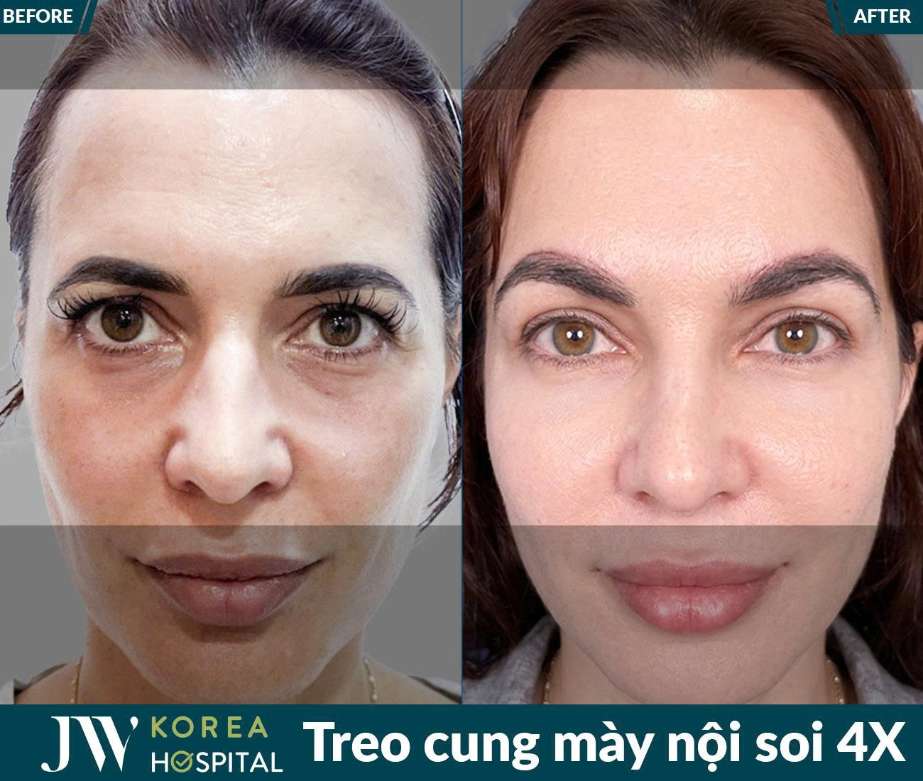 Treo chân mày nội soi 4X