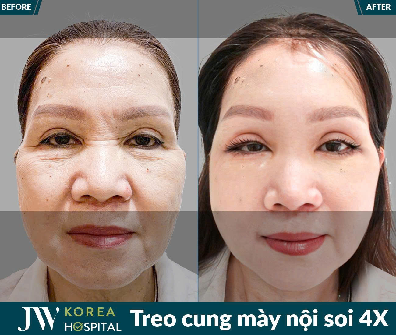 Treo chân mày nội soi 4X