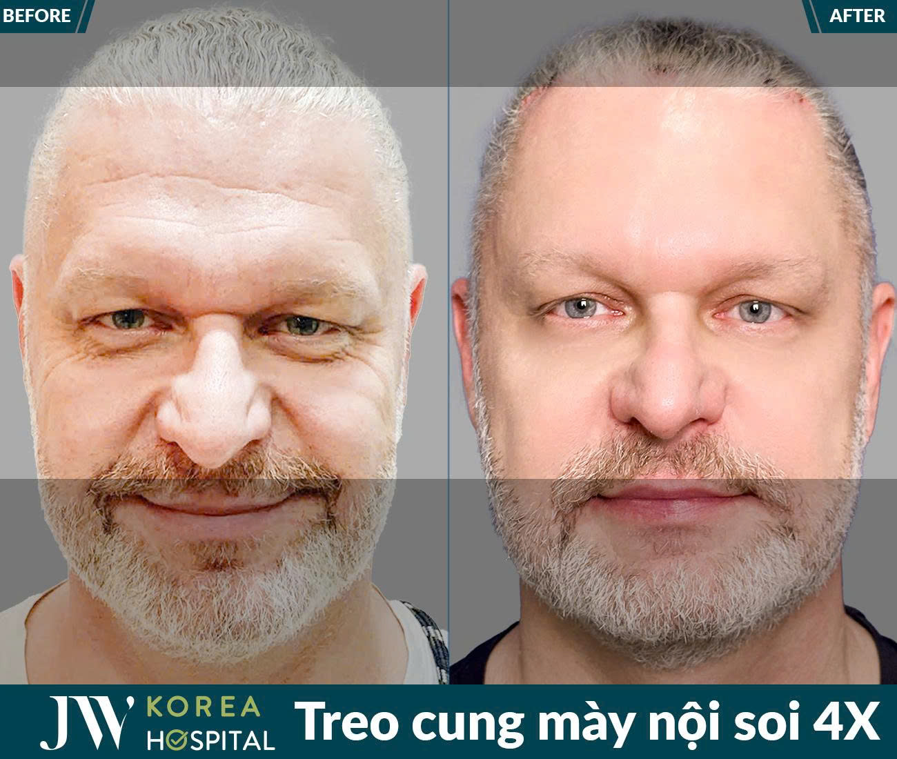 Treo chân mày nội soi 4X