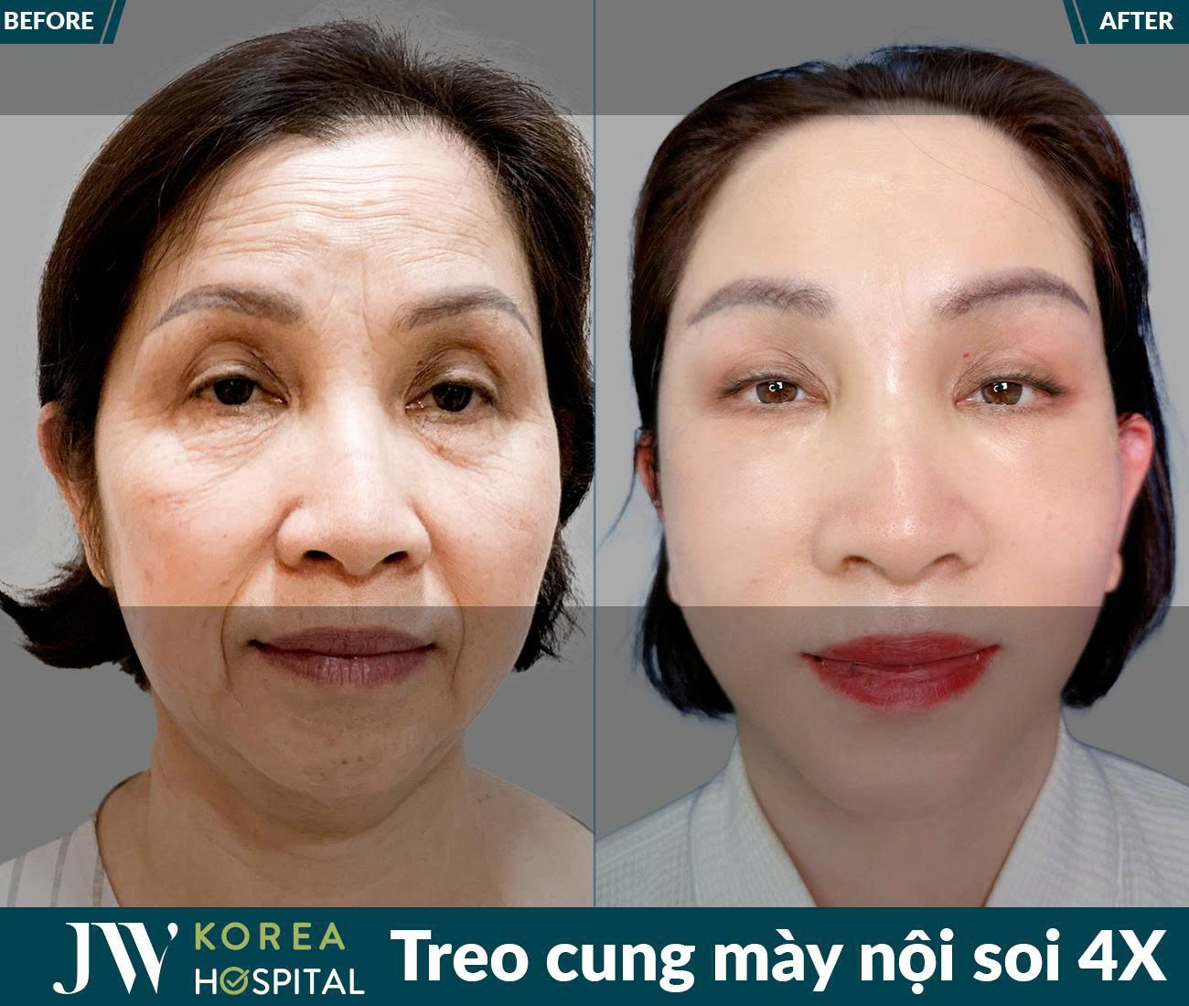 Treo chân mày nội soi 4X