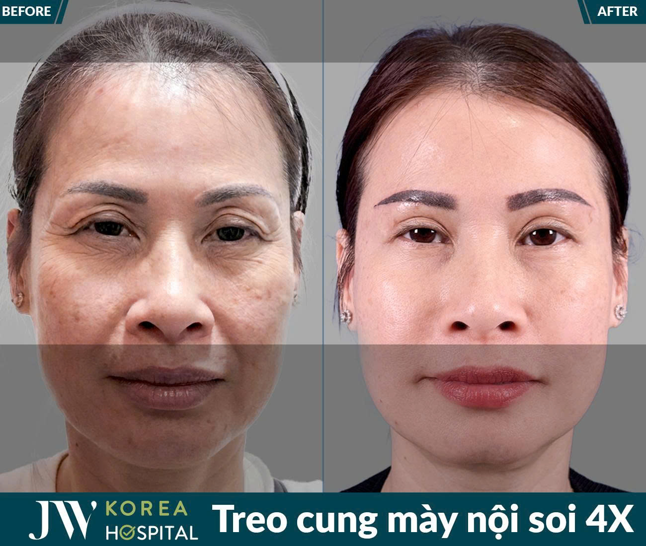 Treo chân mày nội soi 4X